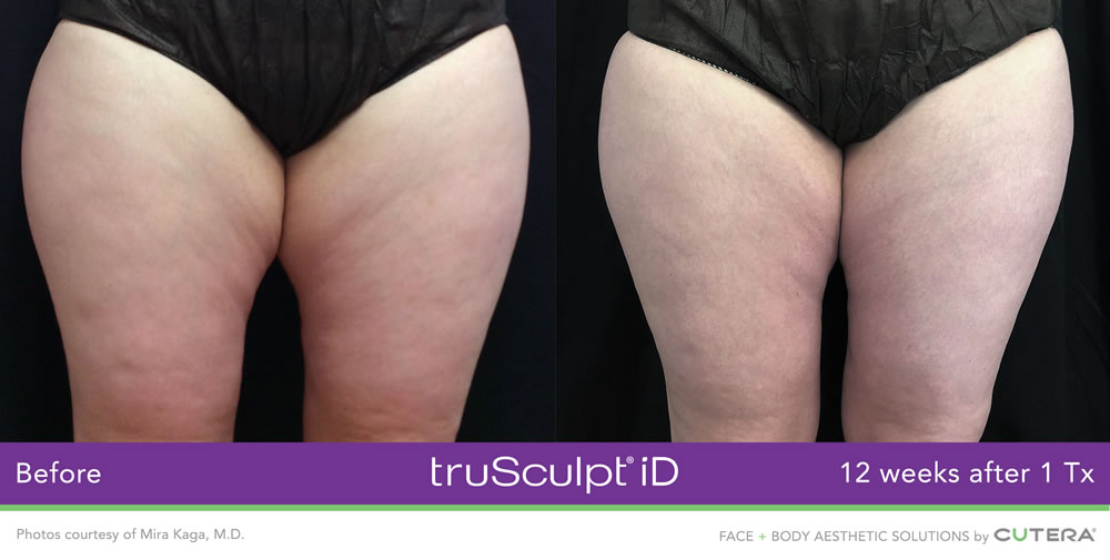 truSculpt iD before and after