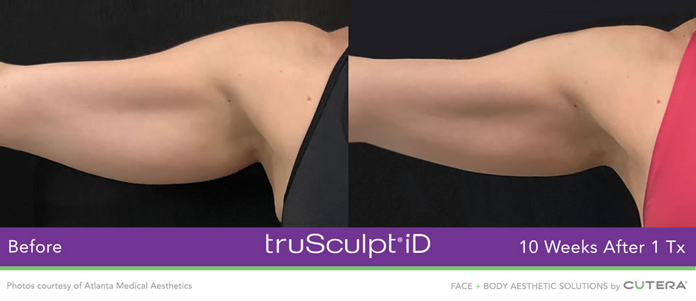 truSculpt iD before and after