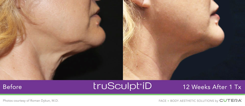 truSculpt iD before and after