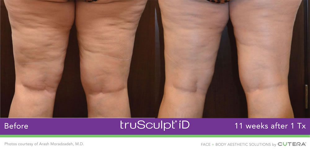 truSculpt iD before and after