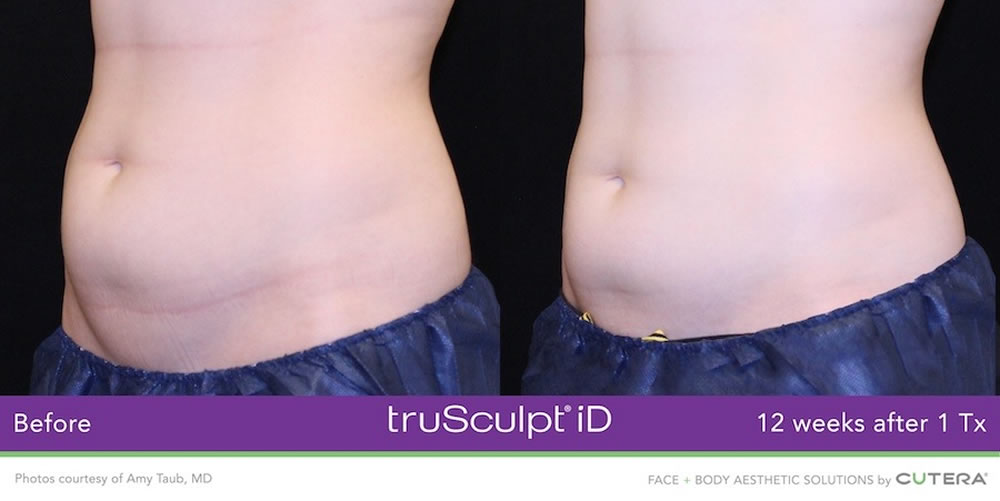 truSculpt iD before and after