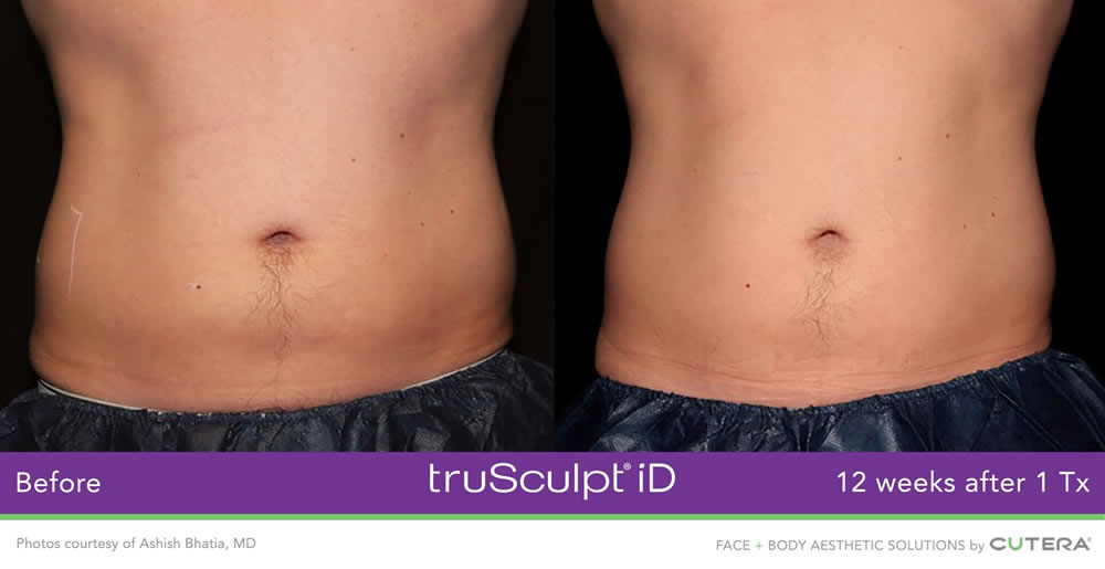 truSculpt iD before and after